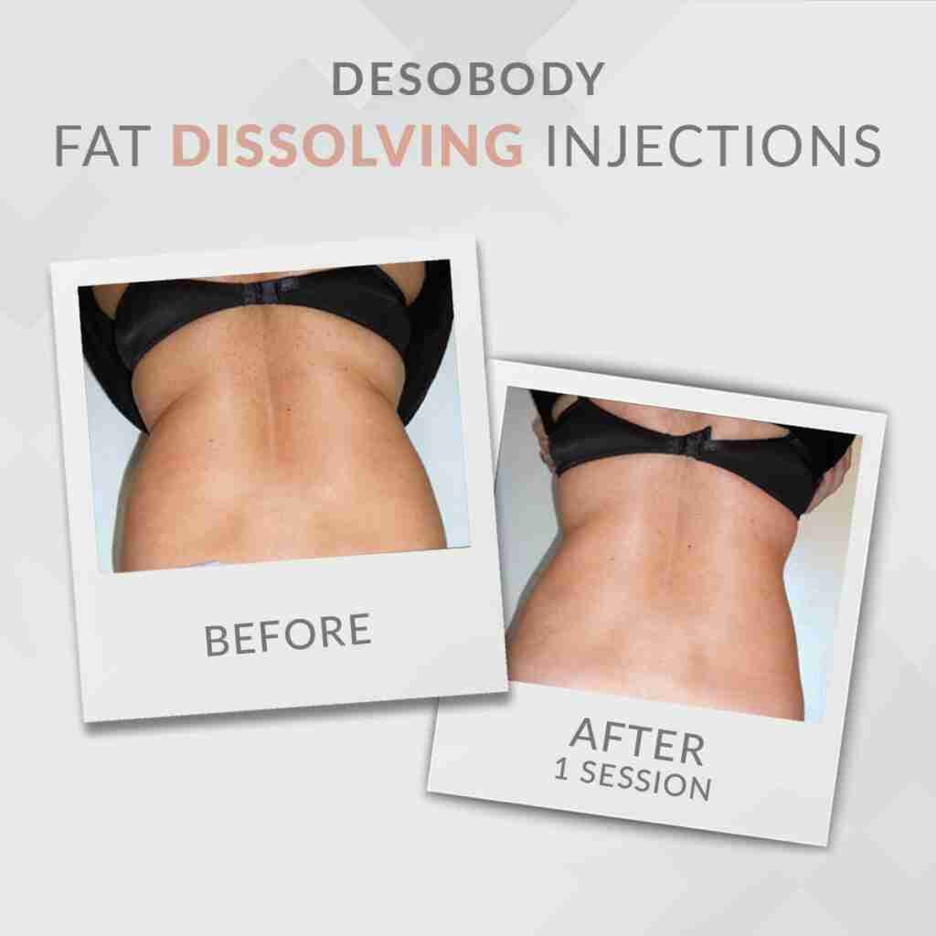 DESObody Fat dissolving injections