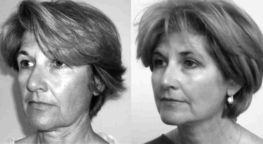 PDO thread lift with cheek filler