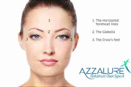 Azzalure brand of botulinum toxin