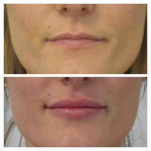 Natural looking Lip filler before and after lip filler near me