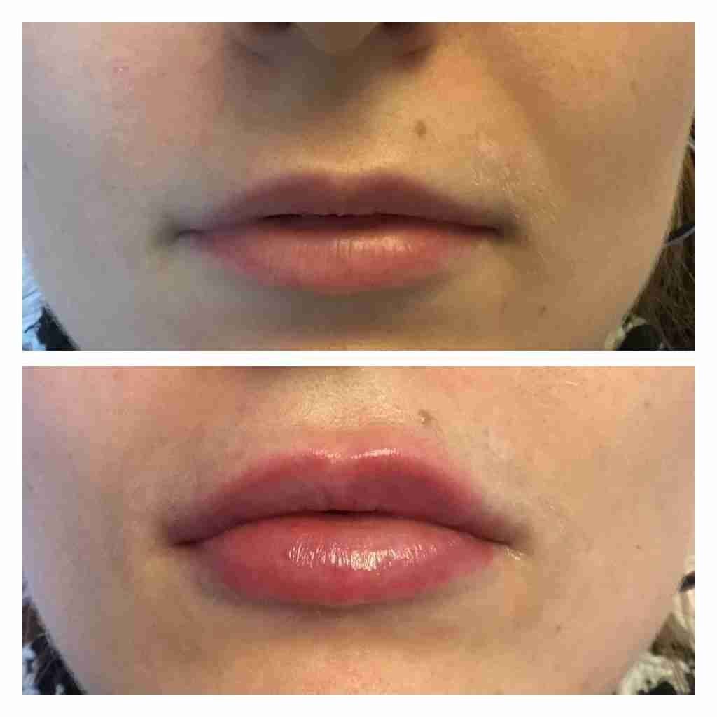 Lip fillers younger person