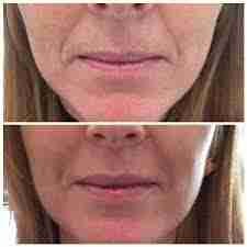 Lip filler small amount