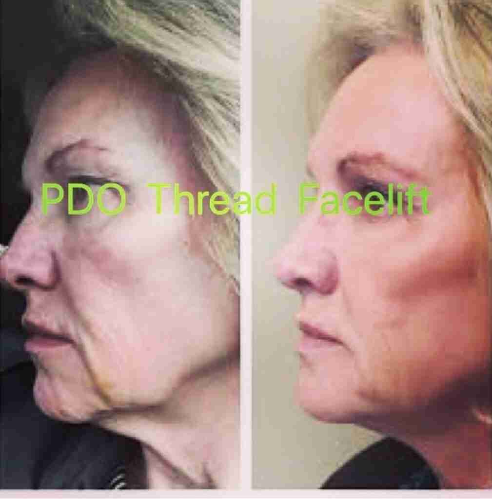 Jowl treatment with PDO thread lift