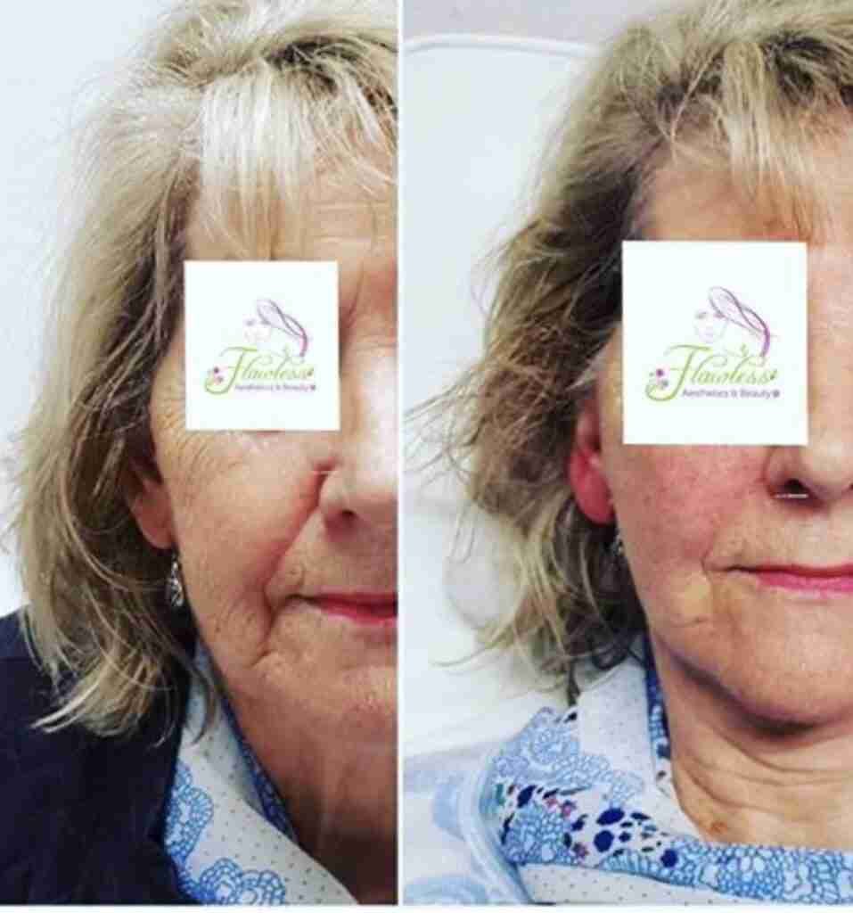 Pdo facelift before and after