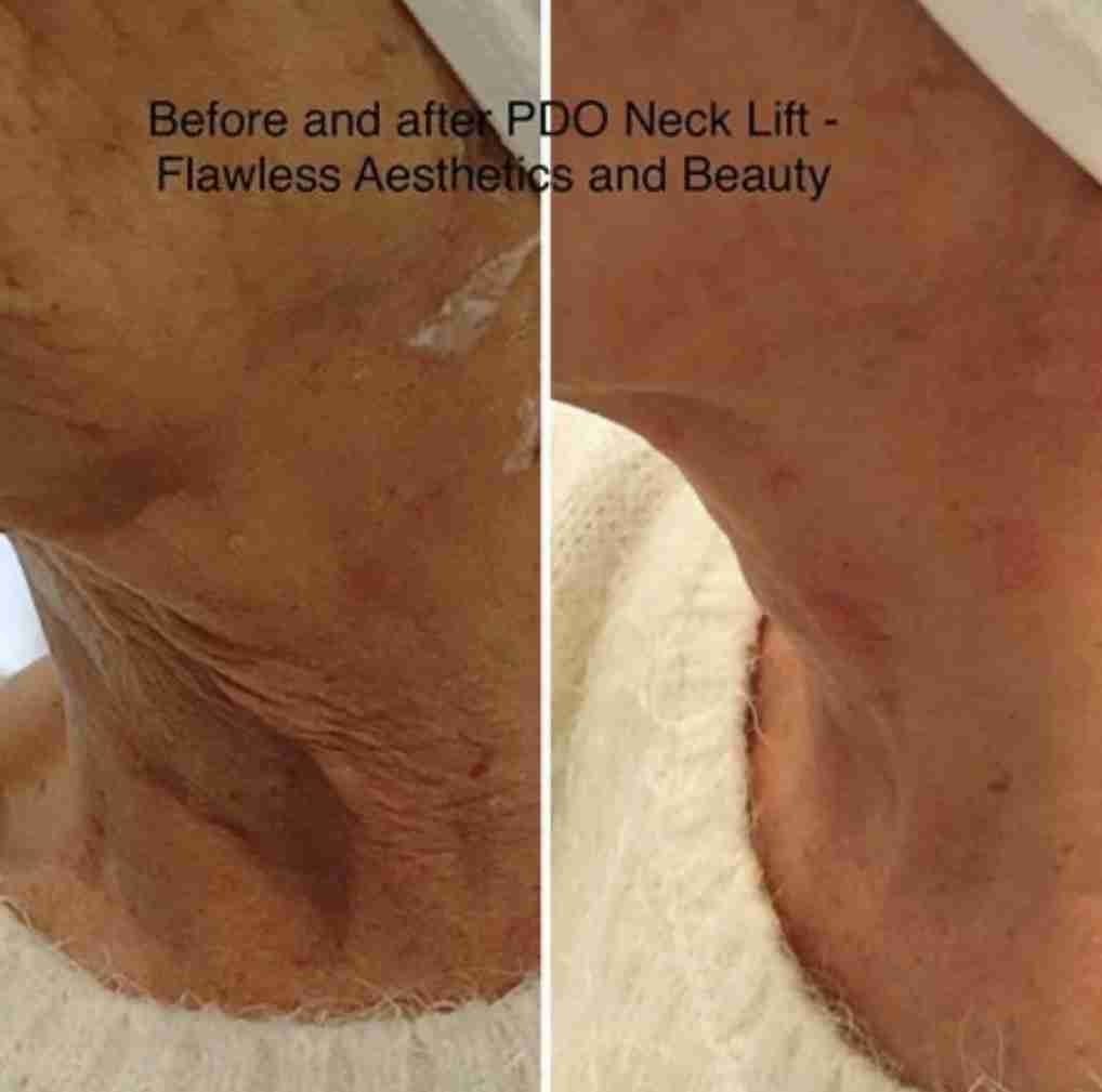 PDO thread lift neck