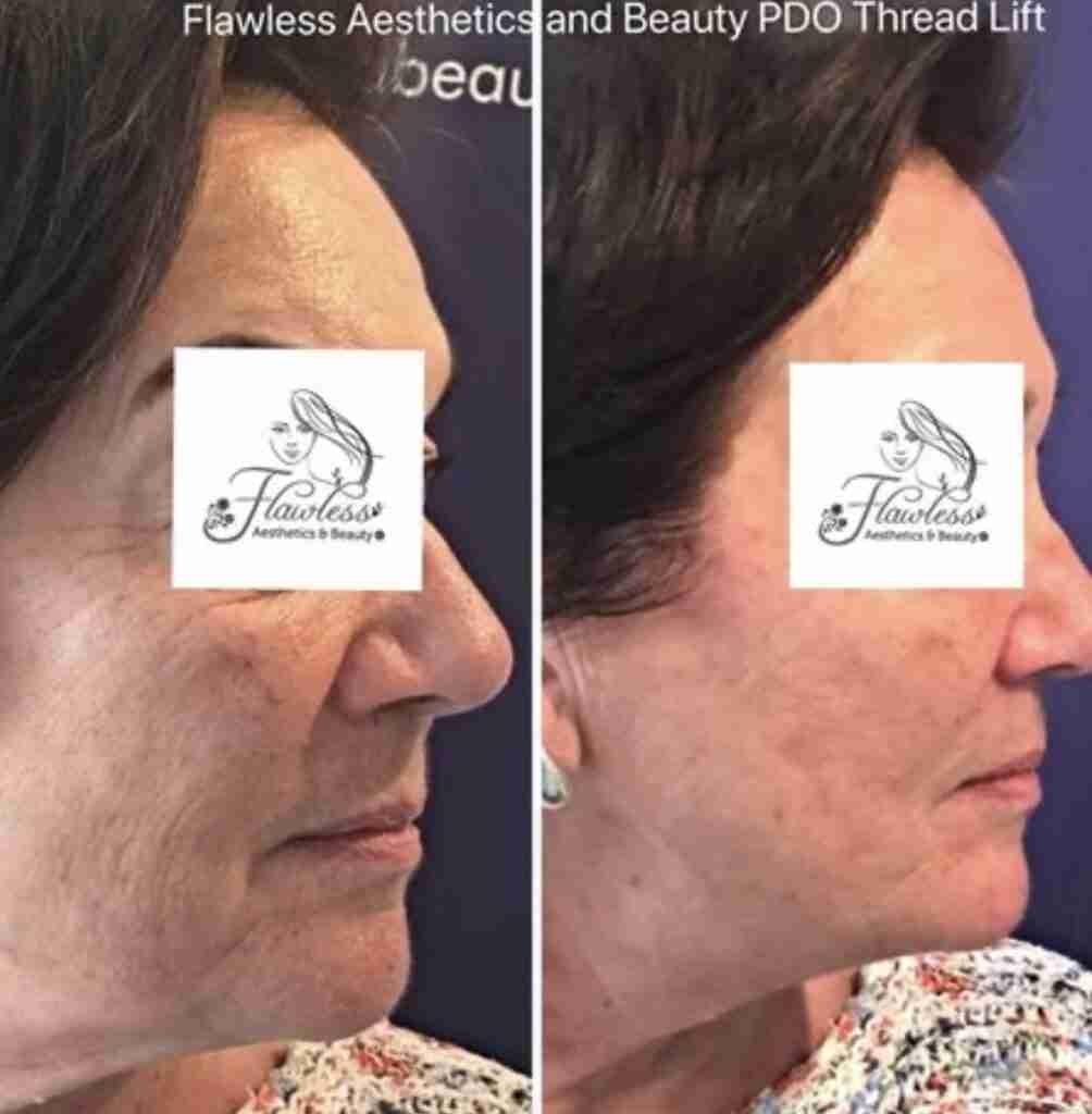 Pdo facelift before and after