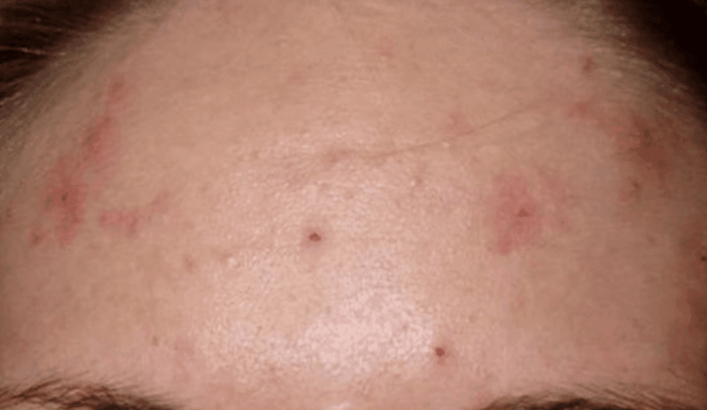 acne clinic - forehead acne