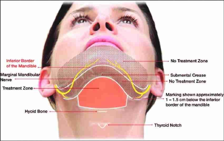Double chin anatomy and treatment