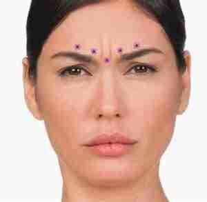 Frown areas botox toxin resistance