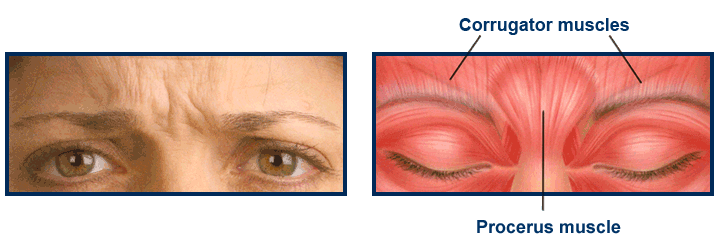 Causes of frown lines
