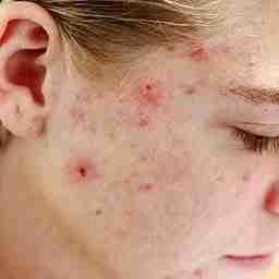 Acne skin