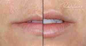 Restylane Lip Filler