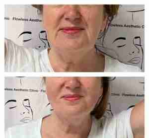 Best aesthetic clinic Before and After PDO Facelift Flawless