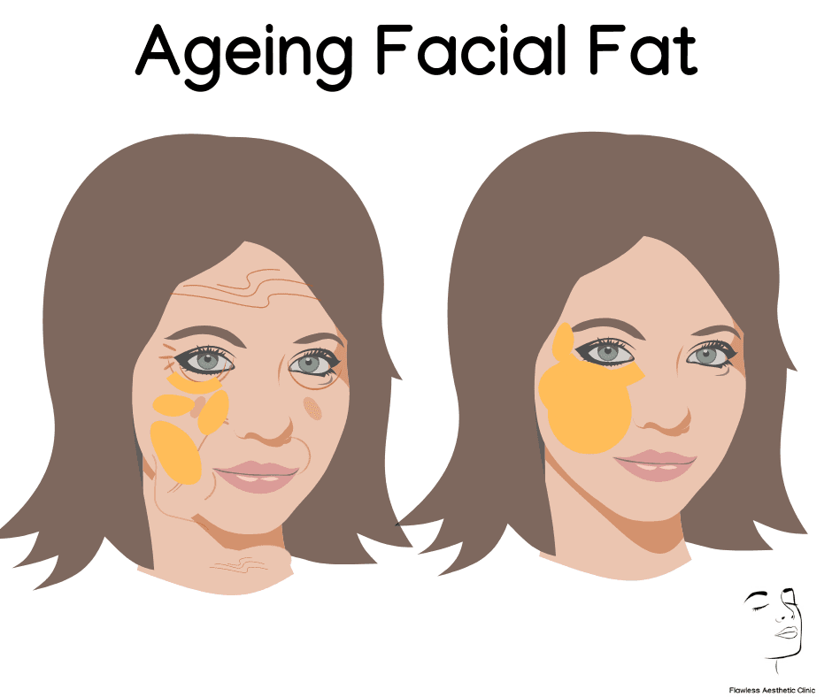 Ageing facial fat Ageing facial fat