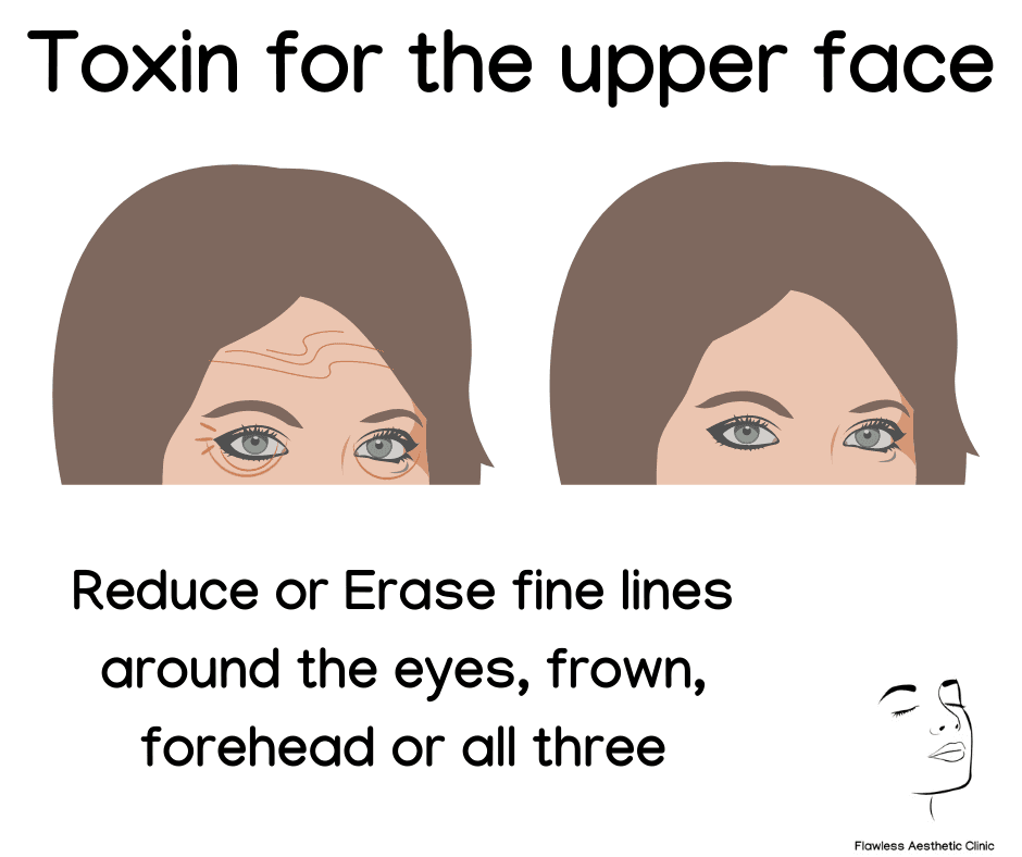 Toxin for the upper face Toxin for the upper face