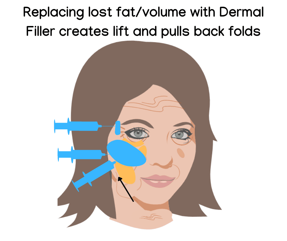 Volume filler placement Volume filler placement