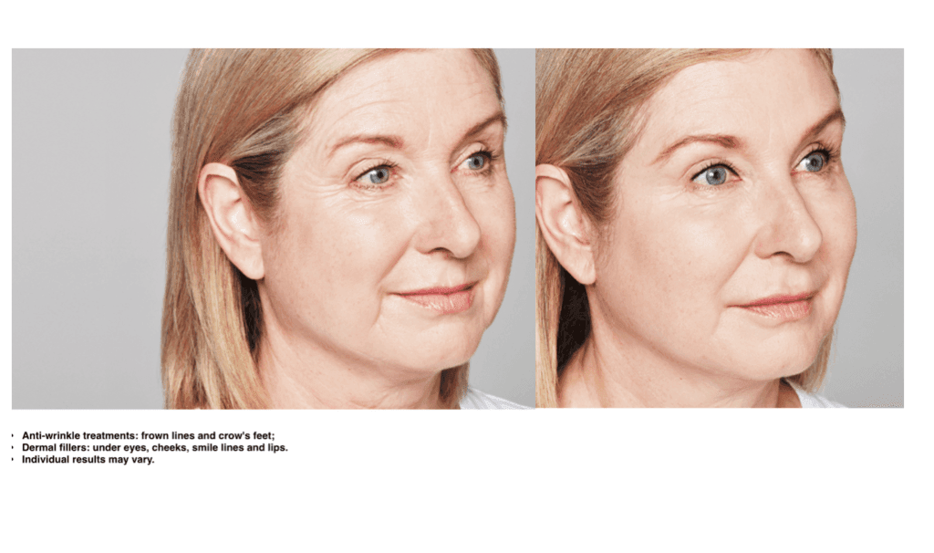 Restylane before and after Restylane Before and After