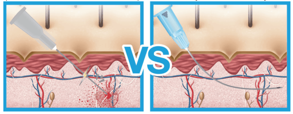 needle v cannula Dermal filler with cannula or needle