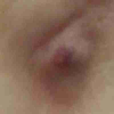 Complications of Dermal filler nodule