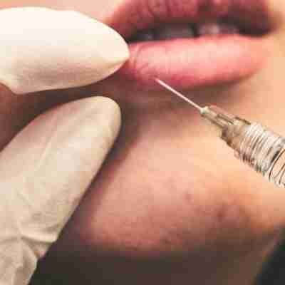 Dermal lip filler injection
