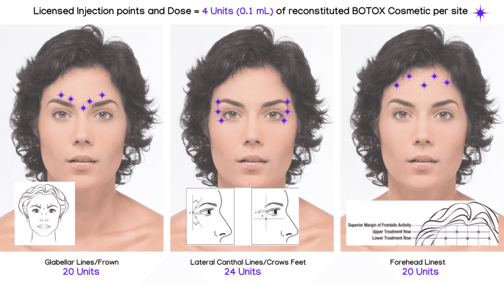Licensed Injection points and Dose = 4 Units (0.1 mL) of reconstituted units of BOTOX Cosmetic per site Units of Anti Wrinkle treatment