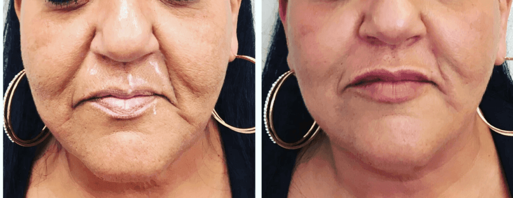 Cheek filler to help lower face