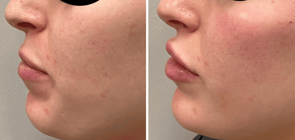 Cheek Filler on cheekbones on Younger patient