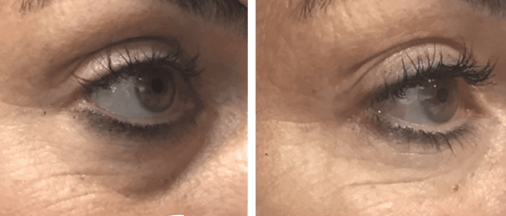 Tear Trough Filler before and after