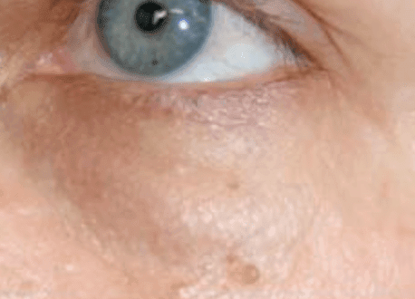 Lump after tear trough filler