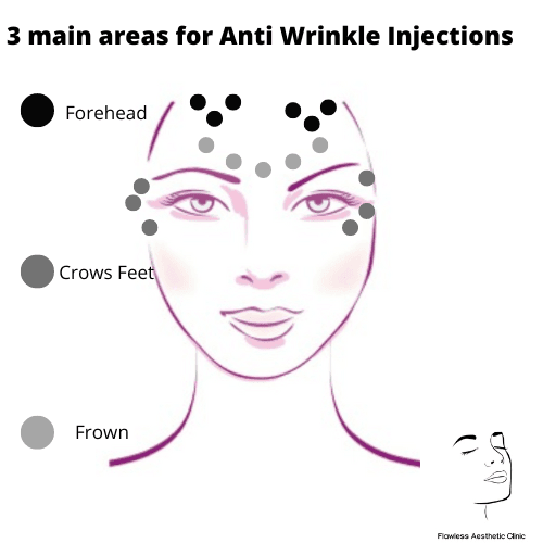3 areas botox
