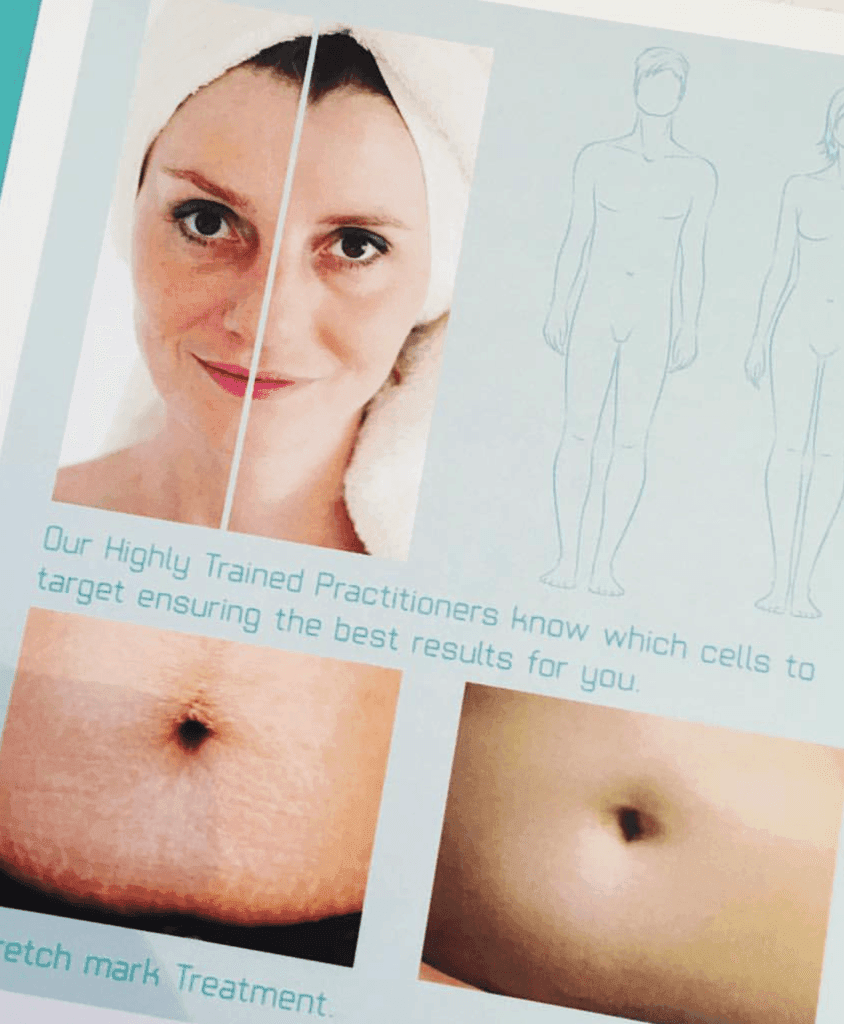 Flawless Pen Microneedling