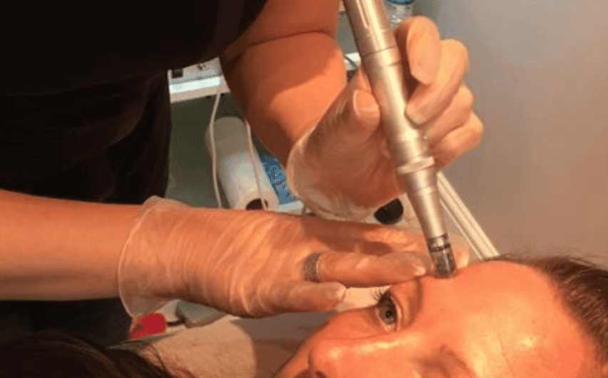 Flawless Pen Microneedling patient