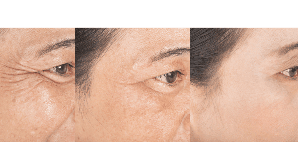 look younger around the eyes