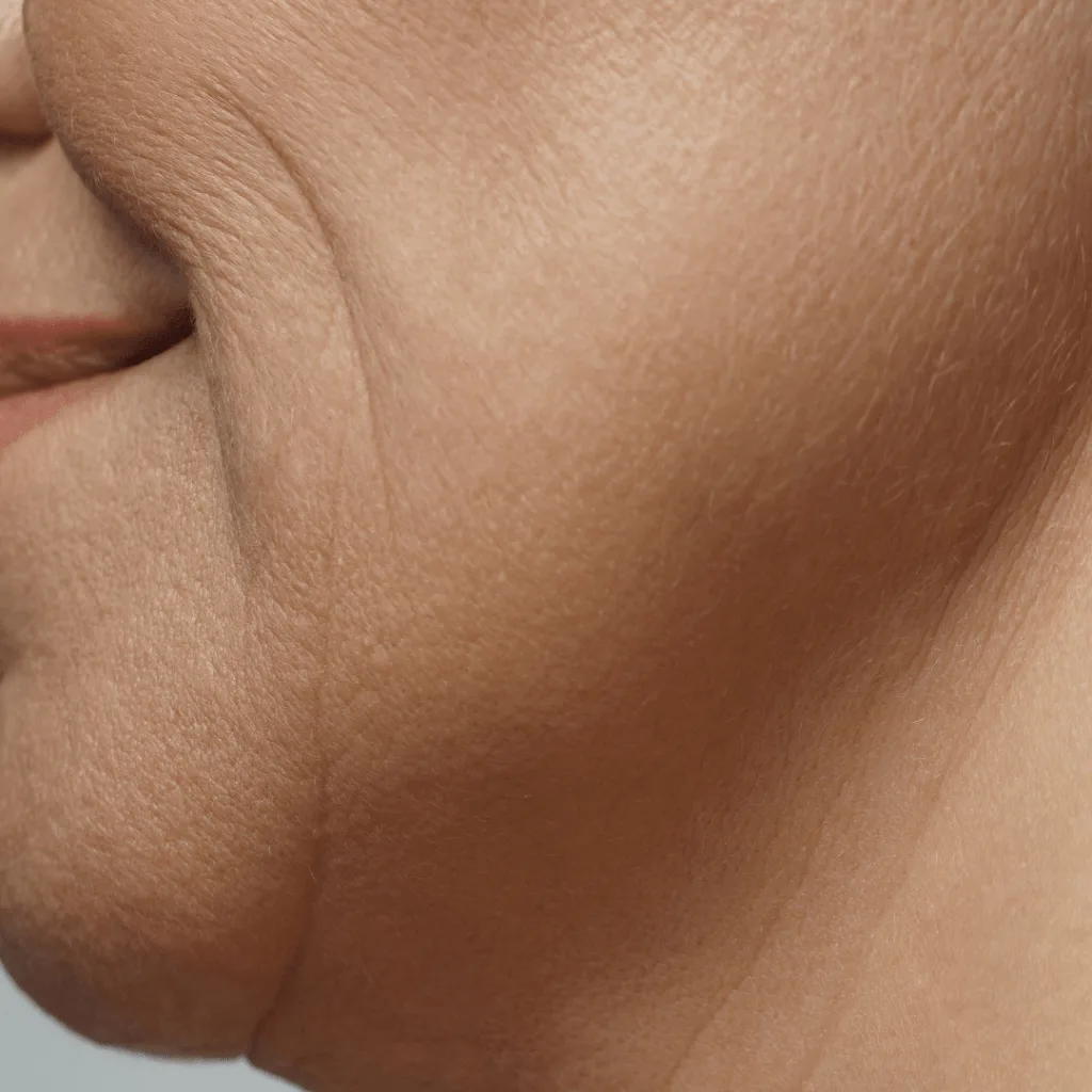 Skin Laxity