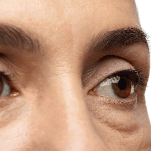 Dark circles