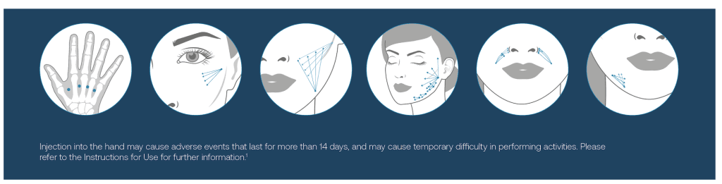 Where to use Radiesse