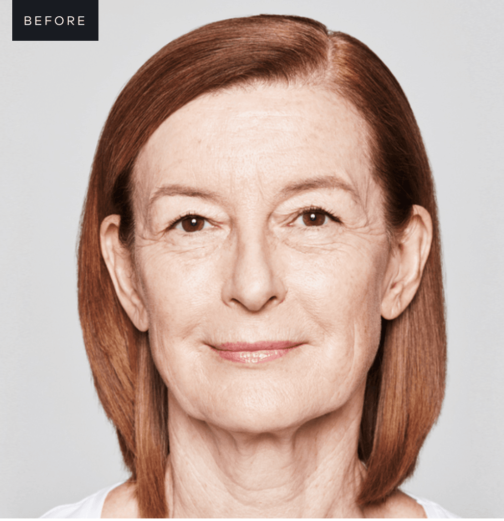Sculptra before and after before